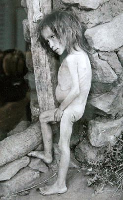 Starvation